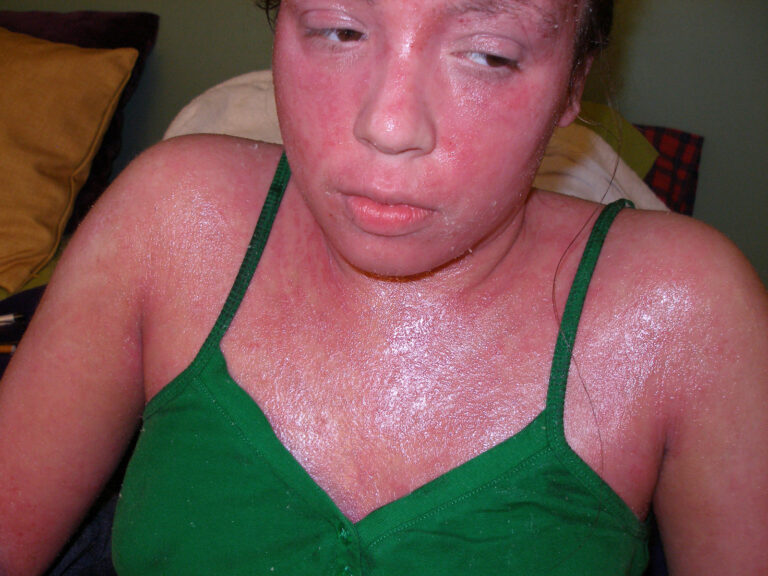 Nina during an intense TSW flare with widespread red, inflamed skin.