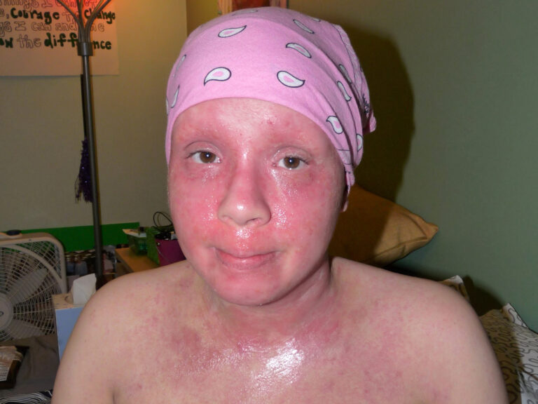 Nina during a severe TSW flare, wearing a pink headscarf.