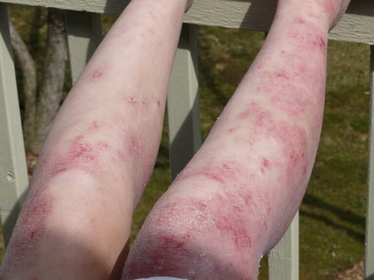 Nina's arms showing inflamed and healing skin in sunlight.
